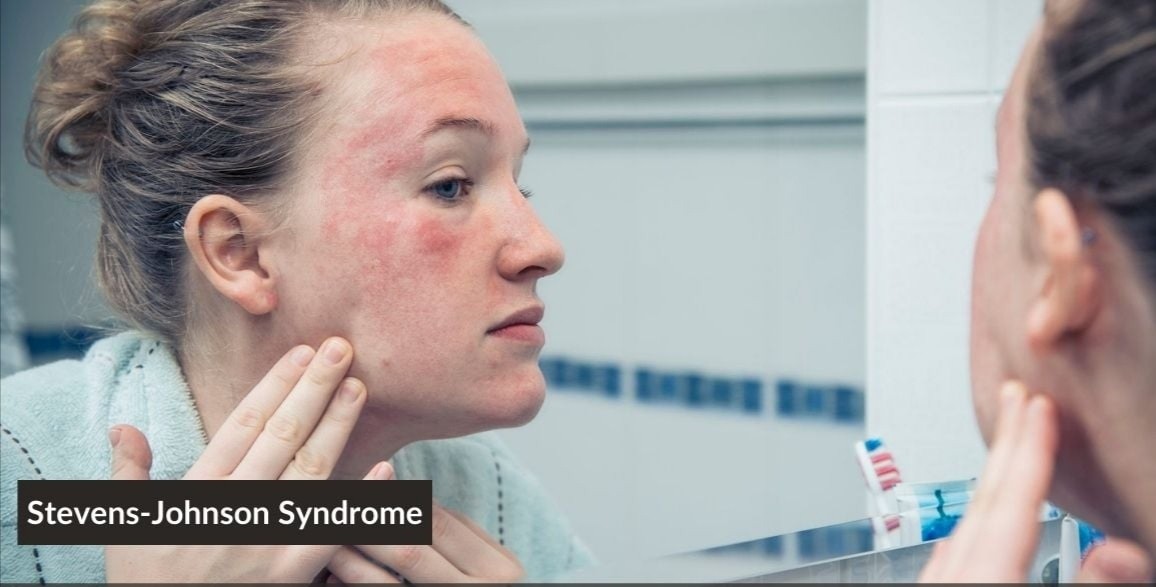 All you need to know about Stevens-Johnson Syndrome