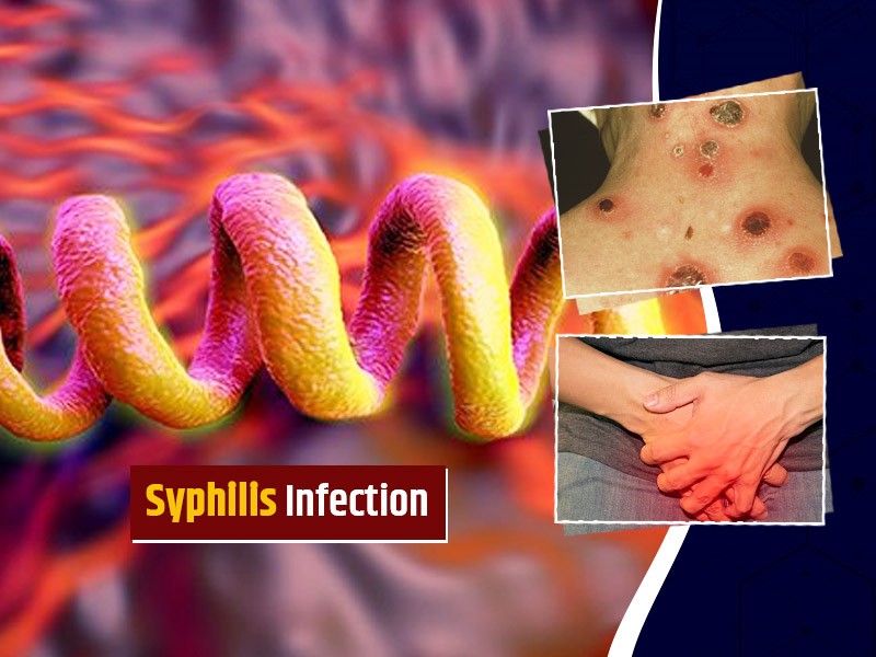 All you need to know about Syphilis