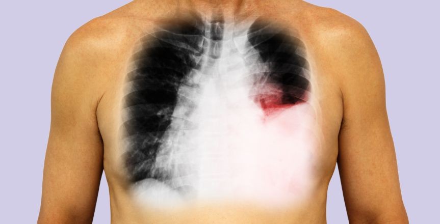 Pleural Effusion